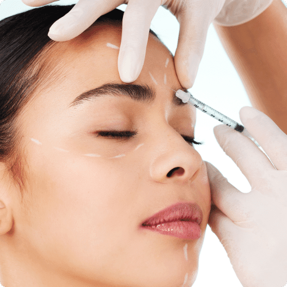 Glabella botox 1
