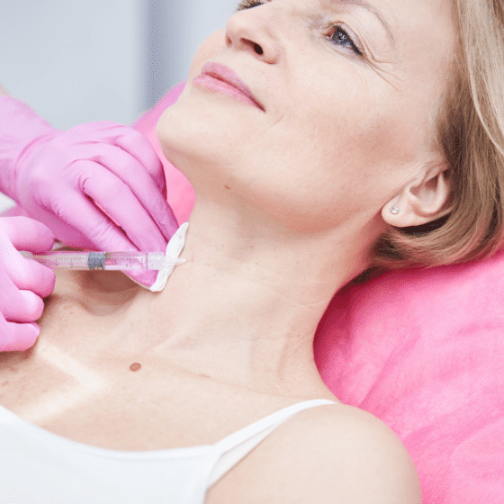 Platysmal Bands Botox 5