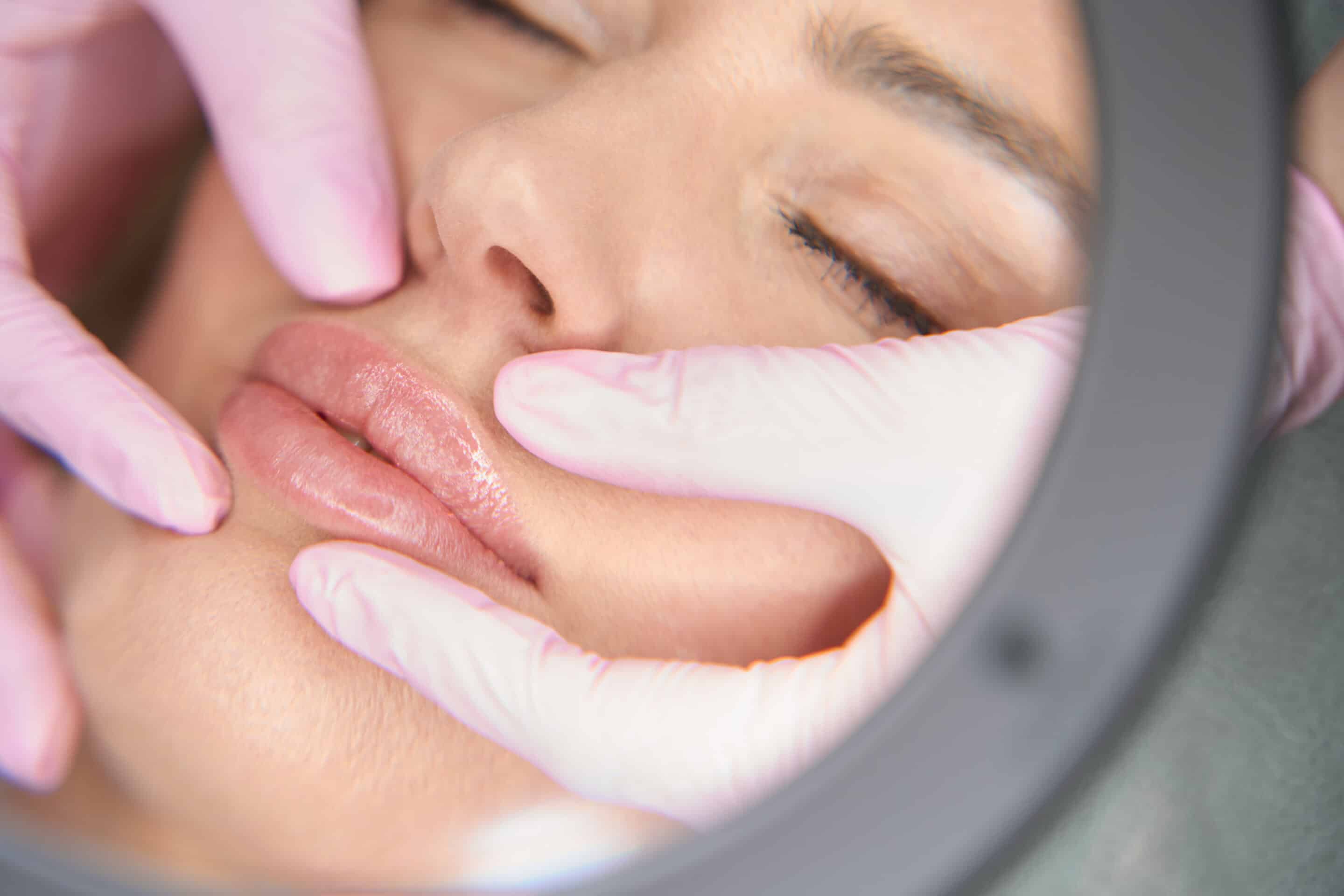 The Ultimate Guide to the Benefits of Botox and Fillers 7 Lip Filler