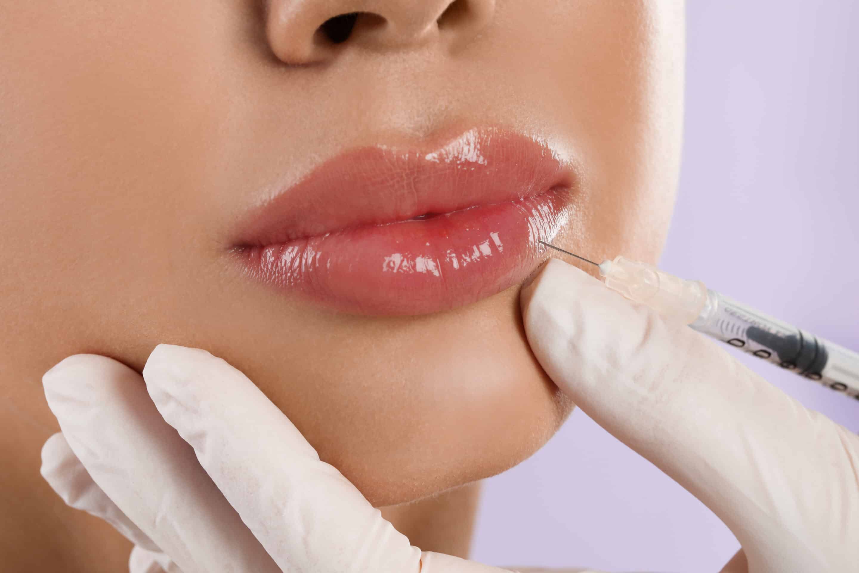 Understanding Your Options: What Is a Lip Filler? 13 Lip Filler