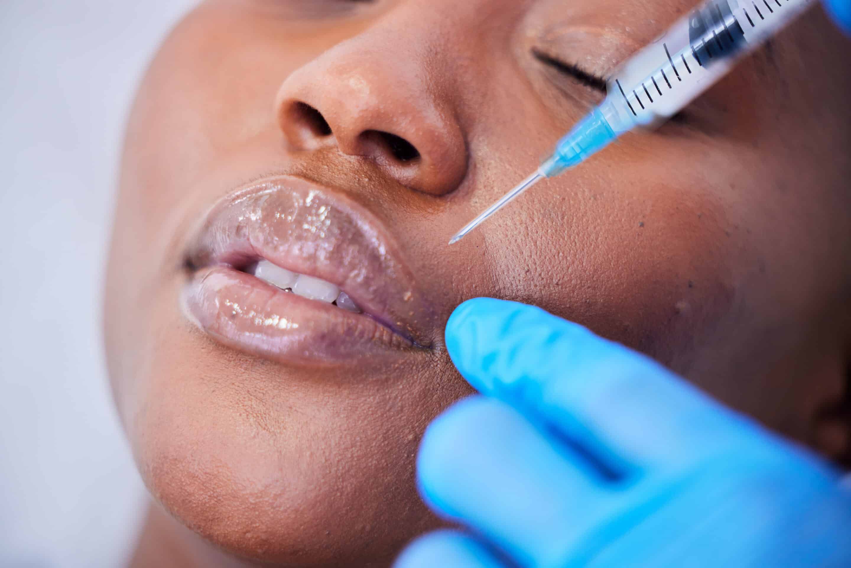 What Not to Do After Lip Filler? 9 Lip filler