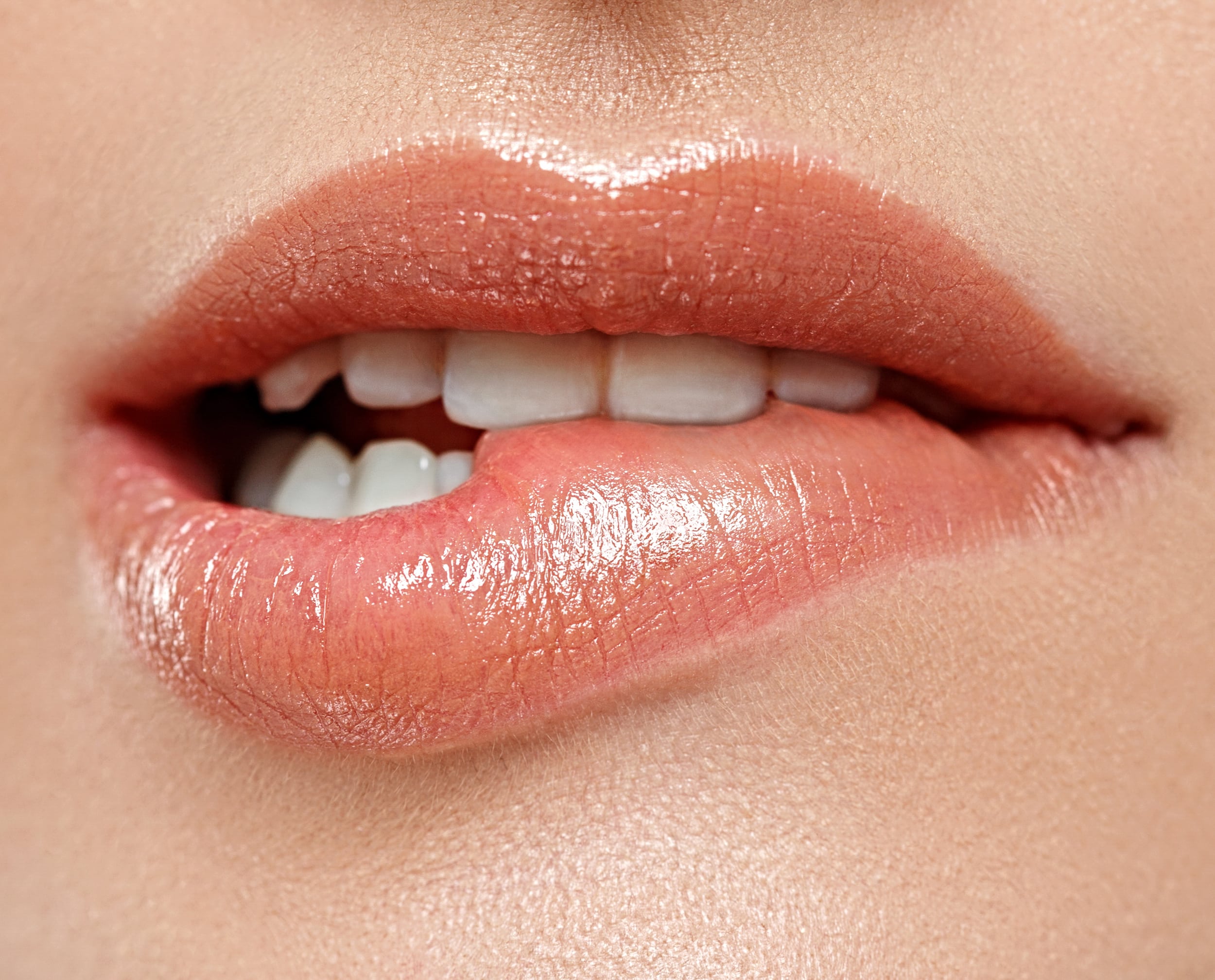 What Not to Do After Lip Filler? 8 Lip filler