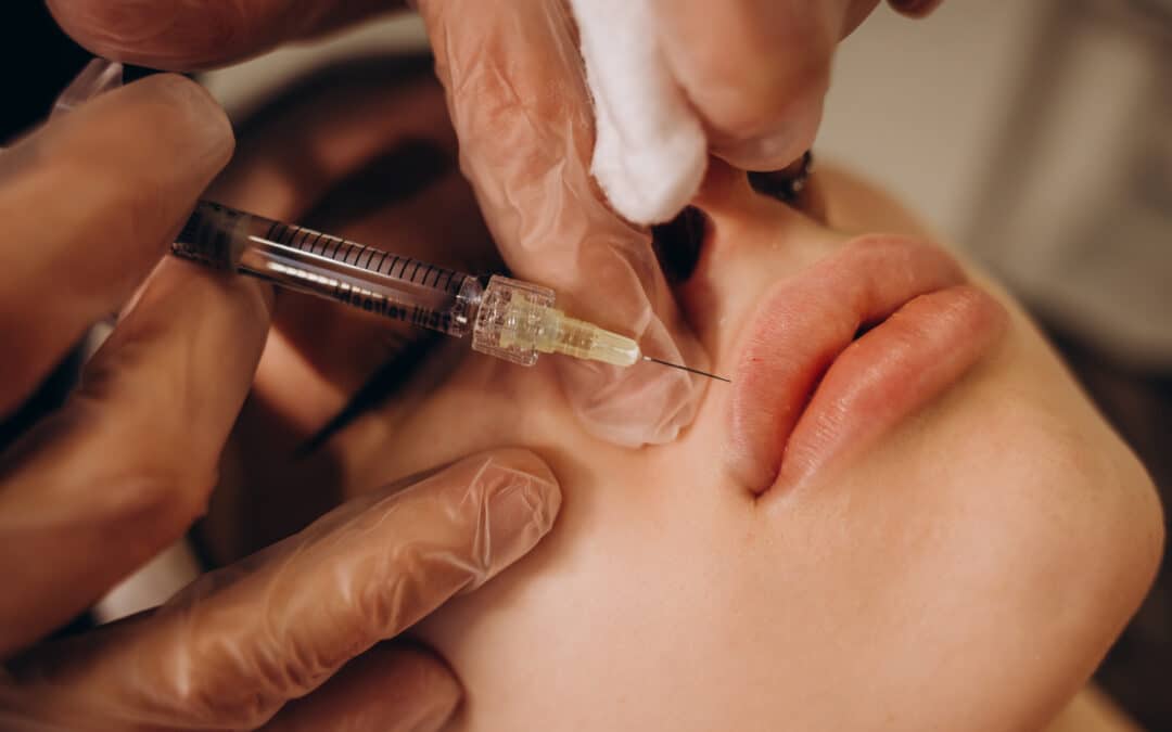 Can I Get Lip Fillers If I Have a History of Cold Sores?
