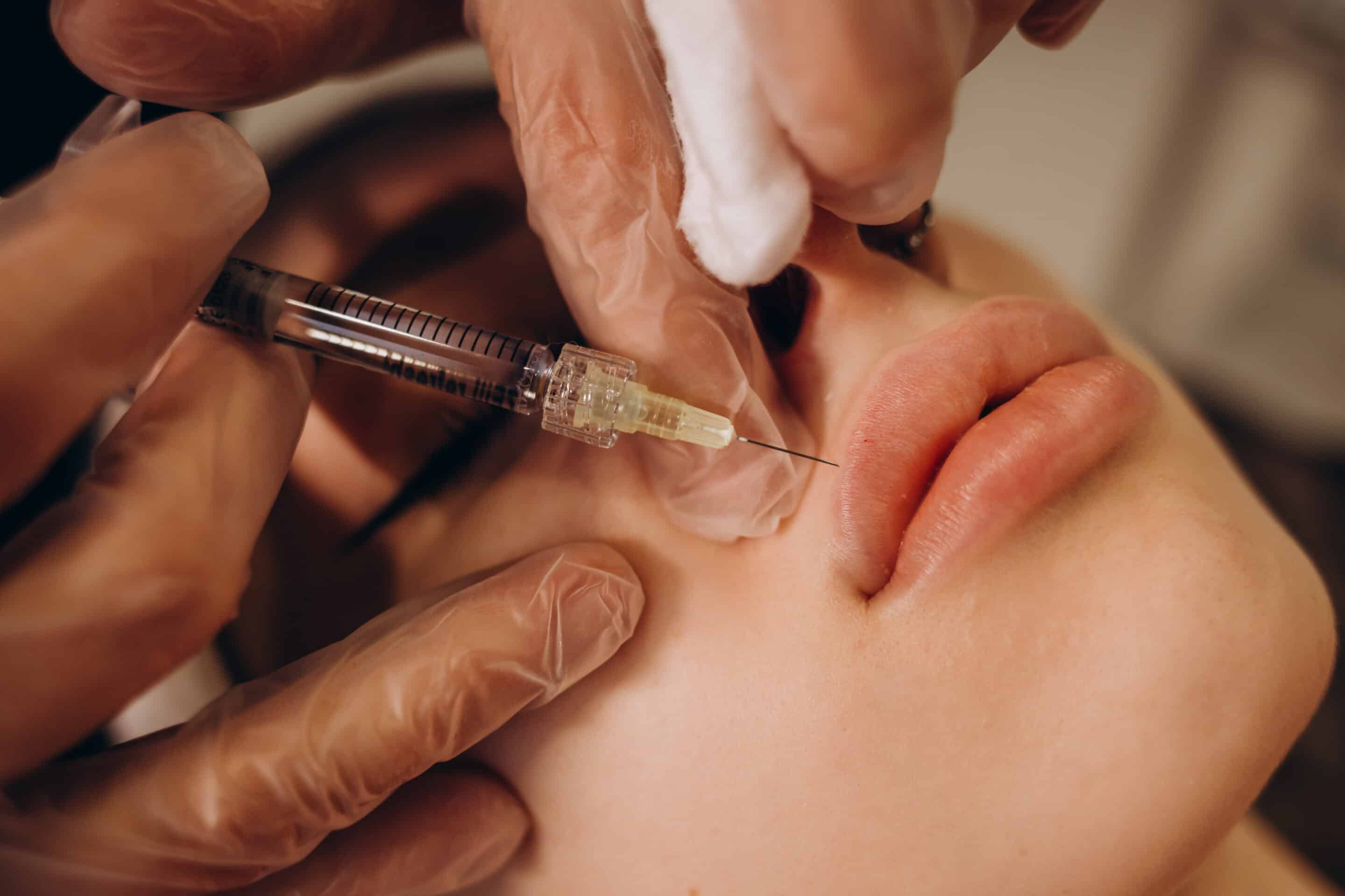 Can I Get Lip Fillers If I Have a History of Cold Sores? 1 Lip Filler